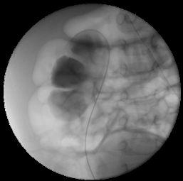 Skiaskopie mikční cystouretrografie MCUG descendentní pyelografie (nefrostomogram)