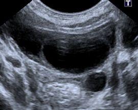Ultrazvuk základní zobrazovací metoda v diagnostice onemocnění močového systému u