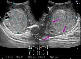 Wilmsův tumor - UZ roztlačuje ledvinu až do tenkého lemu cca 9 % s kalcifikacemi hypo- až