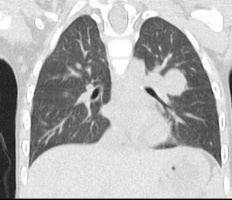 Wilmsův tumor - CT dnes už výjimečně