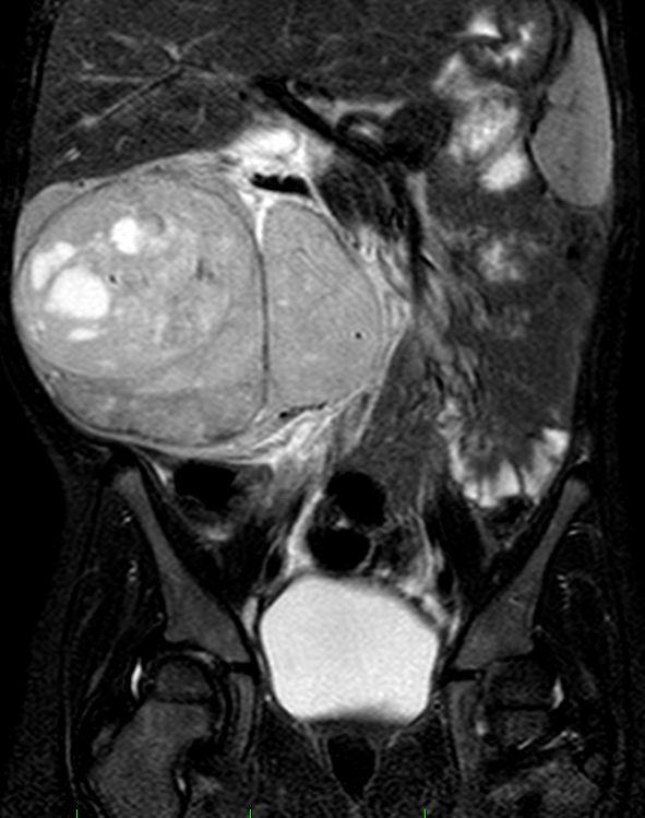 Wilmsův tumor - MR většinou v CA hypointenzní v T1w, hyper- nebo iso- v T2