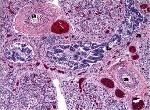 - vzácná letální vrozená porucha vývoje plic - poprvé diagnostikována v 1981 -