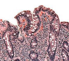 Obrázek 4 Biopsie tenkého střeva ukazující celiakie manifestuje otupení klků (http://en.wikipedia.org/wiki/coeliac_disease) 1.