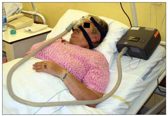 Příloha 5, Neinvazivní ventilace- CPAP, (nosní maska) Zdroj: ČSNN. Obstrukční spánková apnoe a CPAP má význam řešit nosní průchodnost? [online]. 2015 [cit.