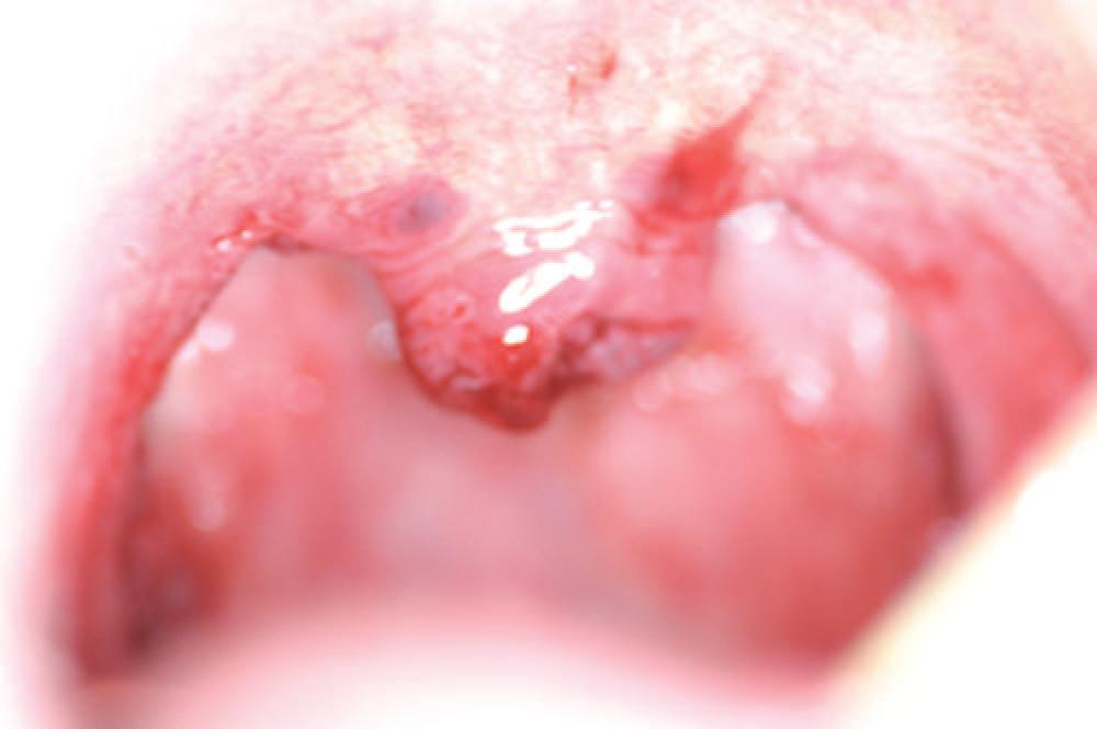 Use of Er,Cr: YSGG Versus Standard Lasers in Laser Assisted Uvulopalatoplasty for Treatment of Snoring.