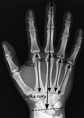 37 Obrázek 18. RTG snímek ruky s naznačeným měřením záprstních kostí a celé délky ruky (Mik et al., 2016). 3.5.