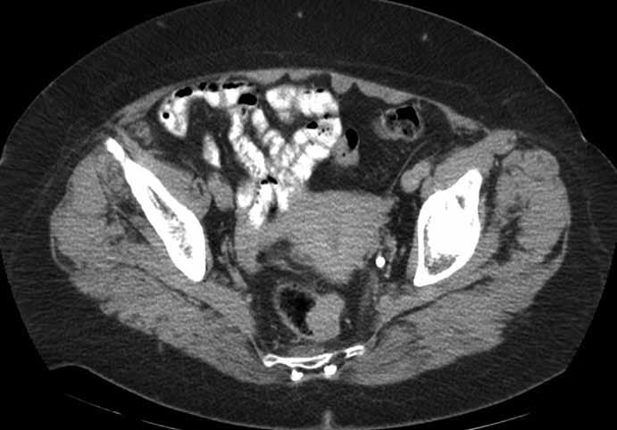 Obr. 1. CT vyšetření gastrointestinální stromální tumor rekta. Obr. 2. MRI vyšetření gastrointestinální stromální tumor rekta. diska mezorektální excize vyžadovaná, přesto je ale doporučovaná.