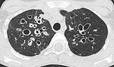 Bronchiektázie ireverzibilní dilatace bronchu cylindrické x varikózní