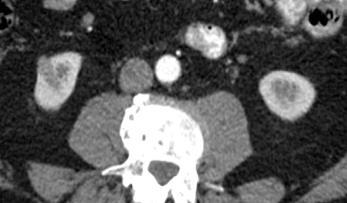 Světlobuněčný RCC gr I-II CT