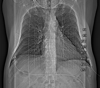 Obr. č. 6 Nativní vyšetření srdce, které je základem pro zhotovení kalciového skóre je vyšetření spirální. Vyšetřovací parametry jsou uvedeny v tabulce č. 4. Tabulka č.