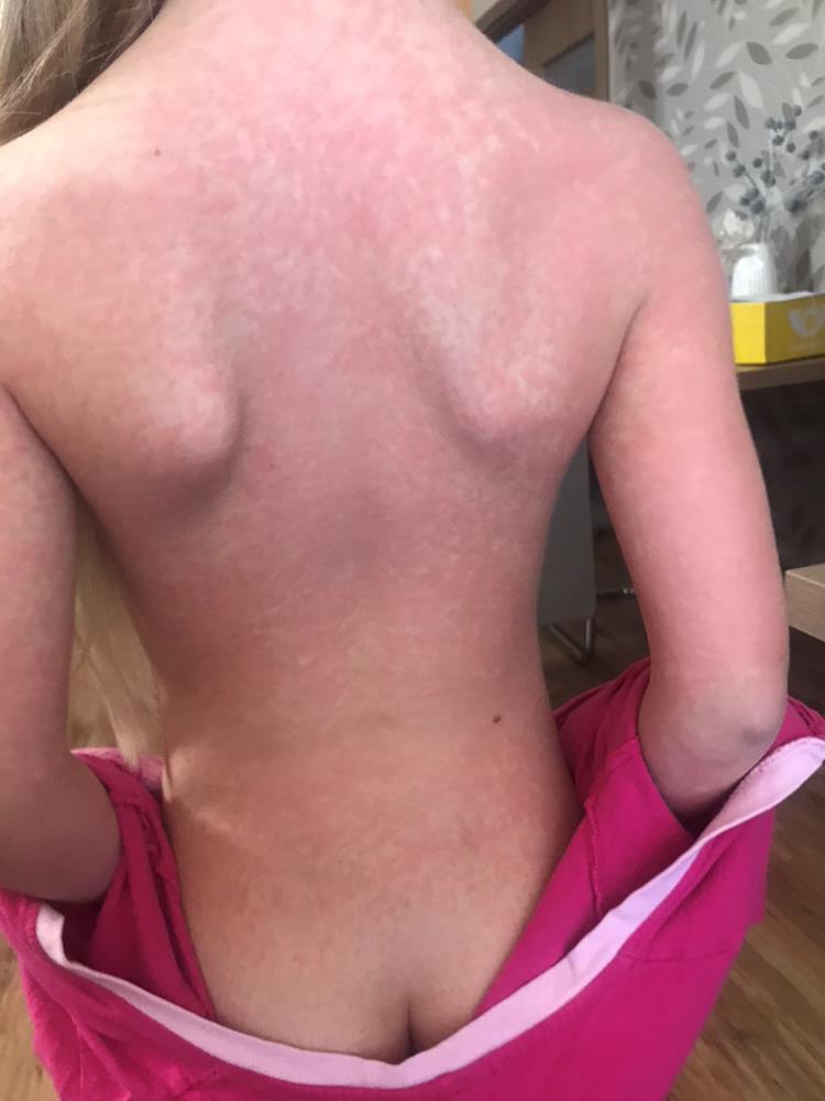 Při přijetí Schvácená, afebrilní, dehydratovaná Tachydyspnoická, DF 54/min Saturace