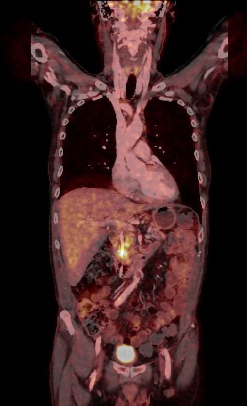 stent, při plnění volně průchozí, proplachujeme a revidujeme kanylou a aspirujeme žluč na kultivaci.