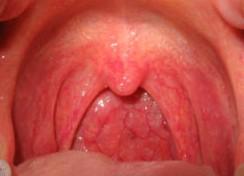 Virová tonsilopharyngitis http://upload.wikimedia.