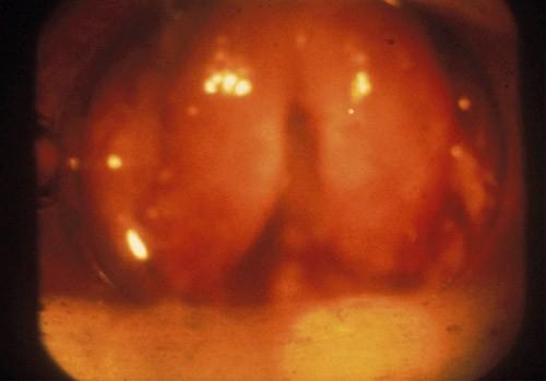 Epiglottitis de.wikipedia.