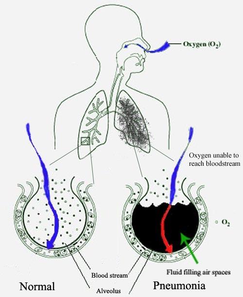 Pneumonie http://www.uspharmacist.