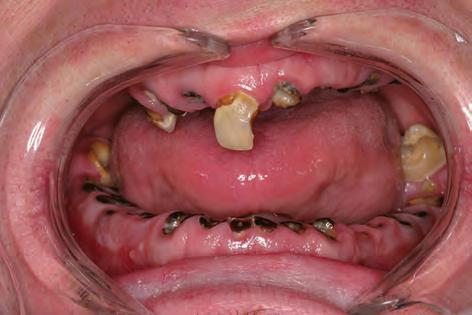 Recenzovaná přehledová práce BULLETIN 2/2017 až se zub zlomí a klinická korunka celého zubu se odlomí. V puse zůstávají shnilé zapáchající kořeny radixy. 5.