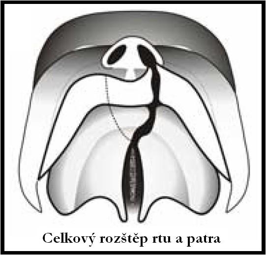 al., 1973). Důsledkem rozštěpu patra v pozdějším věku je zejména ovlivnění a narušení orální komunikace (Pruzansky, 1973). Obr. 2.2. Průběh defektu u pacientů (upraveno dlehttp://uem.testujeme.