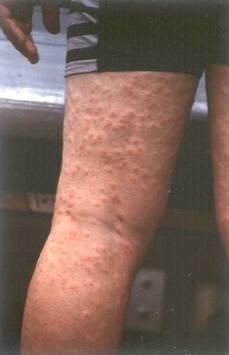 Cerkáriová dermatitida