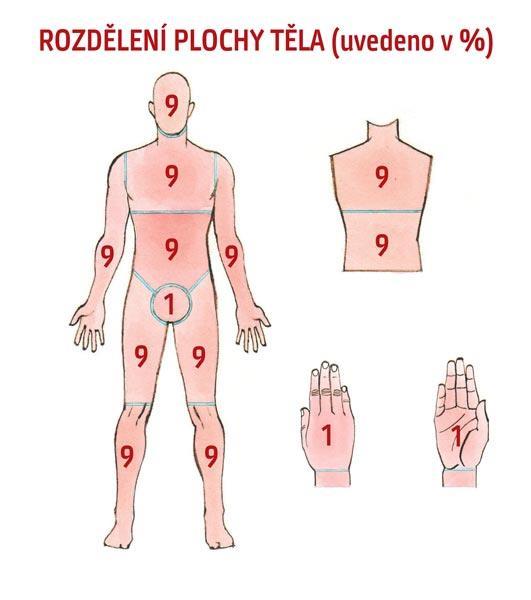 Rozsah postižení Tabulky podle Lunda a Browdera;