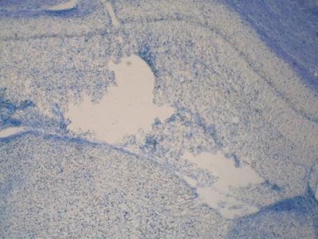 memantine NMDA 