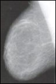 5 Znaky benigního ložiska V mamografickém obraze mají benigní ložiska několik stálých