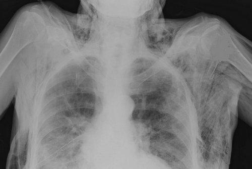 Morfologický obraz VALI Barotrauma přítomnost plynu mimo alveolární prostor pneuomohorax,pneumomediastinum, plicní intersiticální emfyzém, podkožní emfyzém