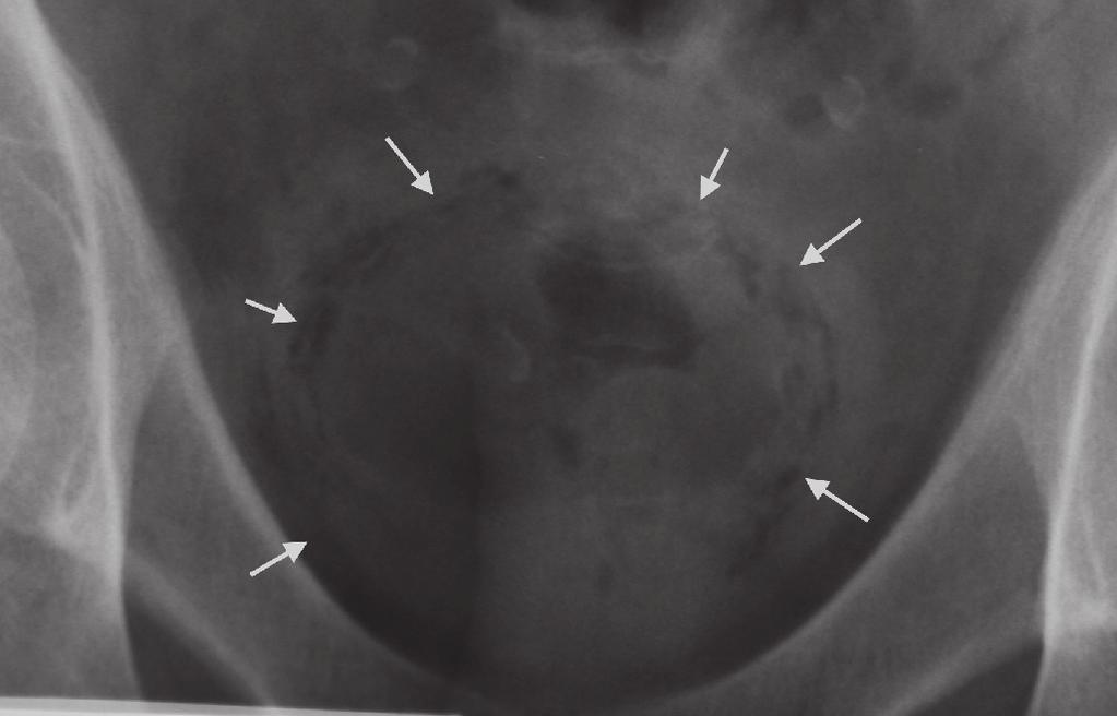 12 moderní farmakoterapie v urologii Diagnostika Pro diagnózu je dostačující kombinace typických obtíží a nálezu v moči může být leukocyturie, přítomnost nitritů nebo mikrohematurie, event.