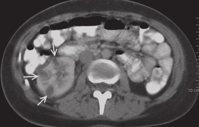 18 moderní farmakoterapie v urologii Klinický obraz Obvyklými projevy jsou bolest v bedru či boku, horečka, může být přítomna nauzea nebo zvracení.