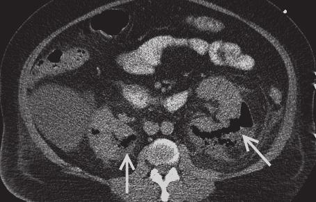 Možné komplikace onemocnění Infekce v urologické praxi 19 Může dojít ke vzniku renálního abscesu a výjimečně k jeho šíření vně ledviny do peri-/pararenálního prostoru formou abscesů nebo píštělí.