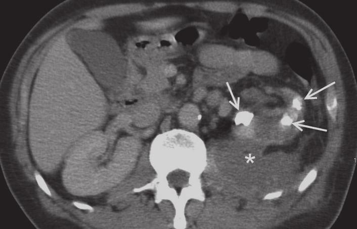 20 moderní farmakoterapie v urologii Obr. 1.6 Xantogranulomatózní pyelonefritida levé ledviny. Zjištěno při vyšetření pro dlouhodobé subfebrilie a pocit diskomfortu v bedru.