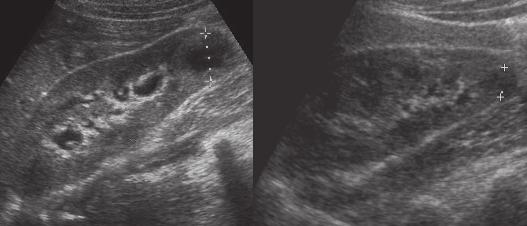 22 moderní farmakoterapie v urologii Obr. 1.7 Úspěšná léčba abscesu dolního pólu pravé ledviny.