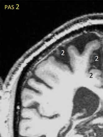 Nakonec zkombinujte PAS pravé a levé hemisféry do jednoho celkového skóru parietální atrofie (PASglob) pro celý mozek podle pravidel v tab. B. Tab. A.