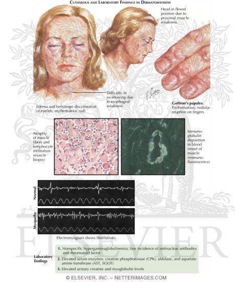 dermatomyozitidou II.
