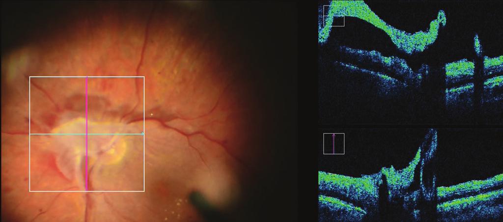 Při operaci byla provedena delaminace proliferací, peeling ILM v makule a endolaserová fotokoagulace.