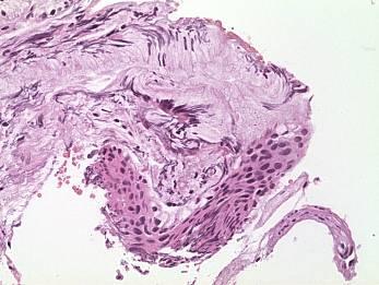 Bioptické vyšetření zjištěné prekancerózy a následné sledování -1.