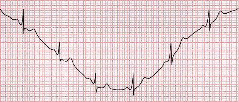 Usek ST- když se rozšíří depolarizace po celé svalovině komor je po krátkou dobu elektrická aktivita srdce nulová (srdeční vlákna komor jsou ve fázi plató, mají tedy stejný elektrický náboj a nikde