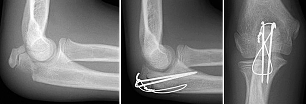 273/ Acta Chir Orthop Traumatol Cech. 85, 2018, No. 4 PŮVODNÍ PRÁCE Obr. 1. 17 pacientů podstoupilo ORCe metodu osteosyntézy otevřená repozice a osteosyntéza tahovou cerkláží. Obr. 2. 20 pacientů podstoupilo CRPP metodu osteosyntézy zavřená repozice a perkutánní fixace zkříženými K-dráty.