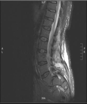 Žena 61 let OUP MR L páteře Epidurální abscesy ve výšce L3 S1 vlevo Subdurální absces v zobrazeném hrudním a