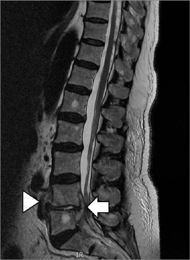 epidurálním abscesem http://www.lf2.cuni.cz/files/page/files/2016/neuroinfekce.