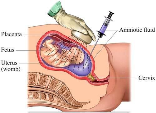 Nahoře odběr plodové vody, AMC Dole odběr choriových klků, CVS Převzato z www.fetalmedicine.org 7. Genetický ultrazvuk Jedná se o podrobné morfologické vyšetření plodu.