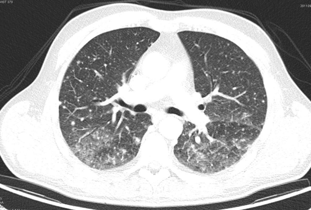 PET/CT: Obě plicní křídla