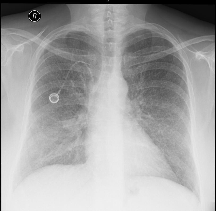 Restagingové PET/CT: minule popsané metastatické ložisko