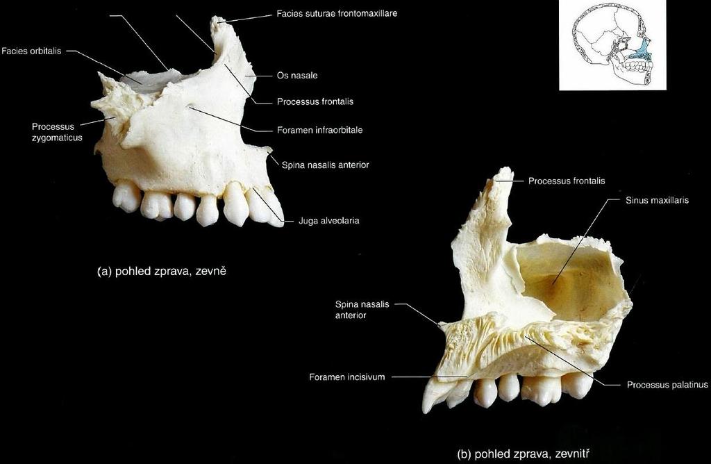 1.1.2 Obličejová část (Splachnocranium) Horní čelist (Maxilla) Tvoří jí tělo (Corpus maxillae) s výběžky (Recesus frontalis, zygomaticus, palatinus, alveolaris) a s dutinou (Sinus maxillaris, Antrum
