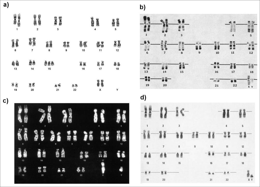 Obr. 2. Metody pruhování chromosomů a) G-pruhování (Sandberg and Meloni-Ehrig 2010); b) R-pruhování (Verma 1975); c) Q-pruhování (Baj et al. 2005); d) C-pruhování (Özkinay and Mitelman 1979) 3.