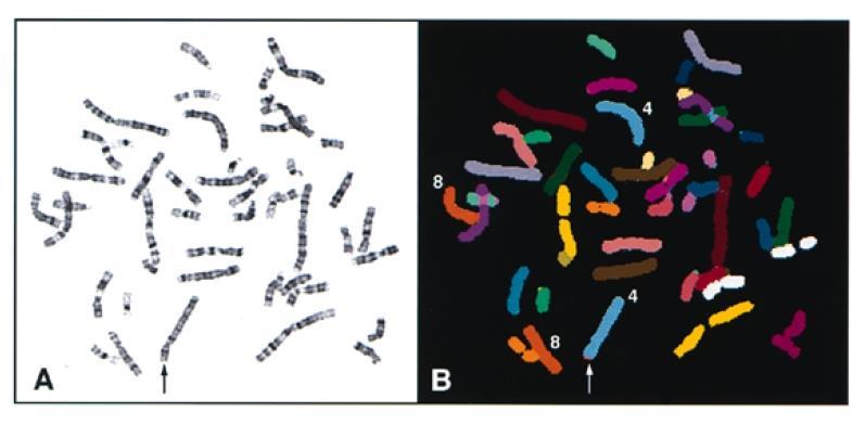 Obr. 5. Analýza SKY využita pro prokázání Wolfův-Hirschhornovo syndromu. A) G-pruhování metafázních chromosomů značí mírnou abnormalitu telomerické oblasti chromosomu 4 (označeno šipkou).