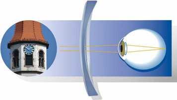 korekční pomůcky při čtení. Vysoké ametropie vytváří dojem lehkého exoftalmu z důvodu zvětšené předozadní délky oka.