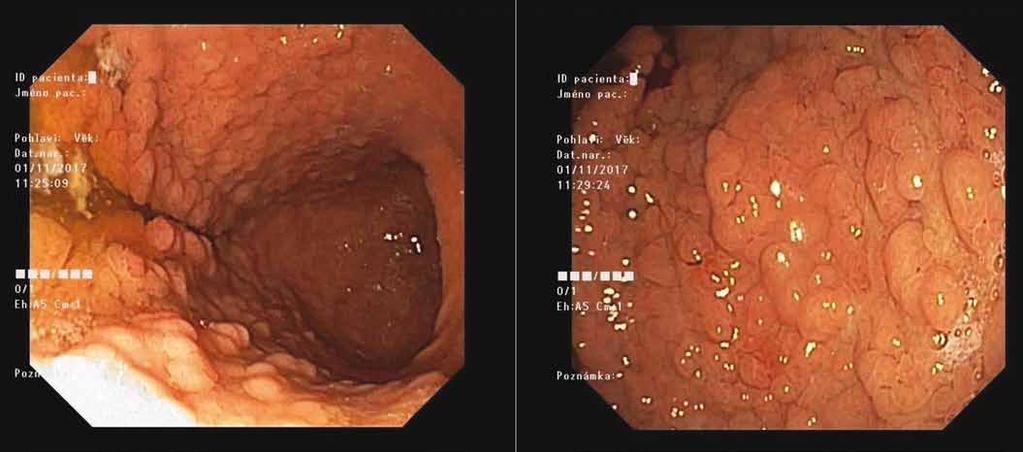Fig. 9. Gastroscopy with massive polyposis of stomach in gastric adenocarcinoma and proximal polyposis of the stomach patient (Masaryk Memorial Cancer Institute). Fig. 10.