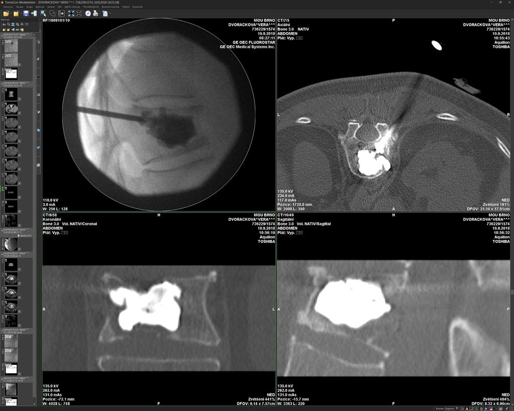 Metastázy do páteře Radioterapie: EBRT analgetický