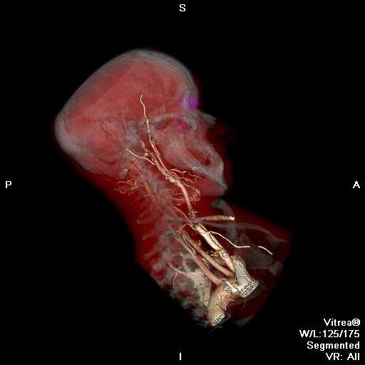 Skeletal-related events, SRE 30% skeletálních metastáz Instabilita Patol.