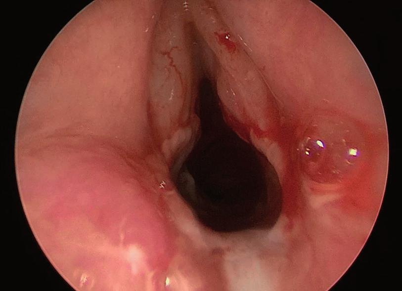 4: Subglotická stenóza stupně III podle Myer-Cottona Etiologie intubace nebo